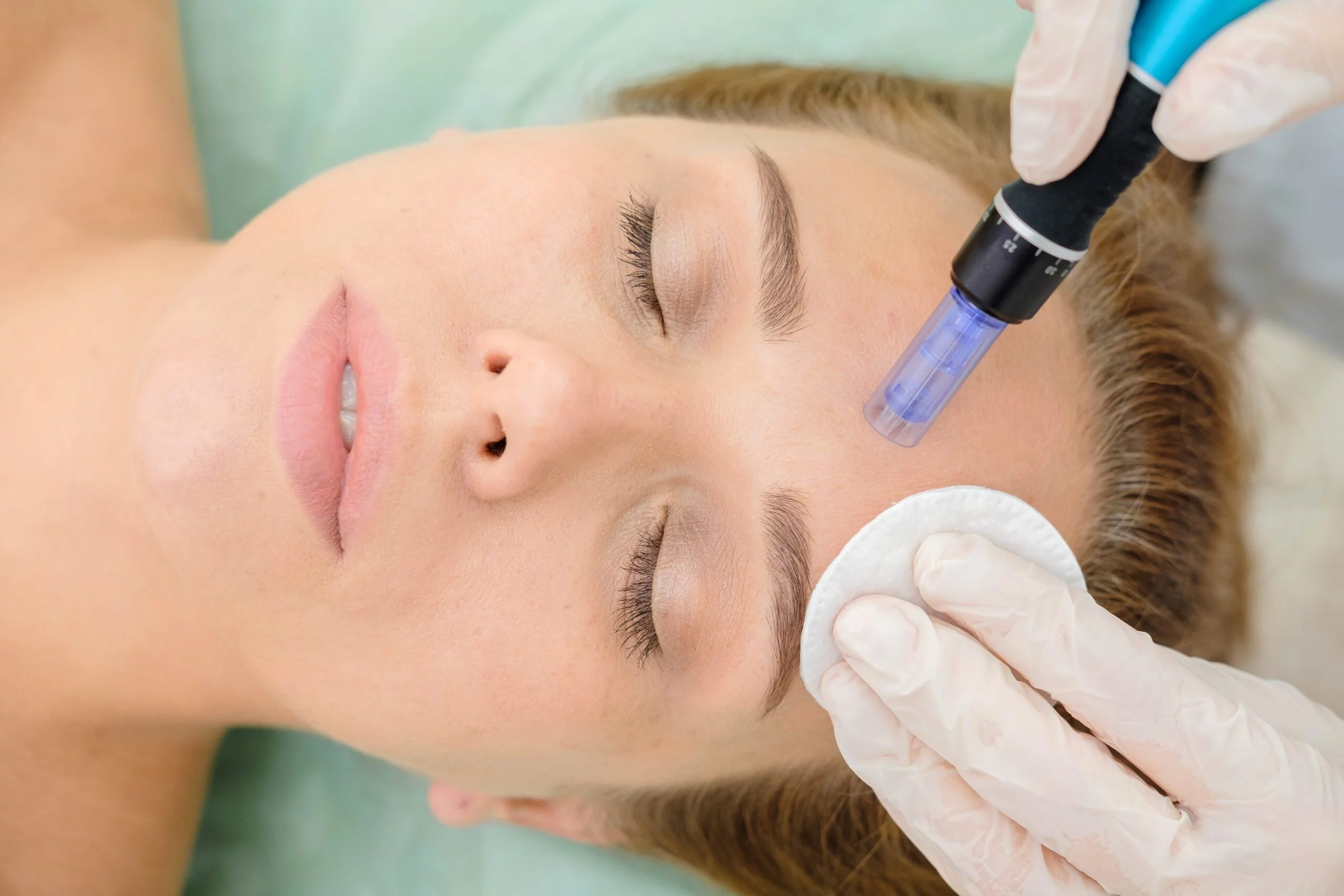 Microneedling Prep and Recovery: Enhancing Skin Rejuvenation